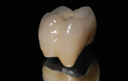 Rekonstrukcija zuba metalo keramičkim krunicama