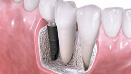zubni implanti