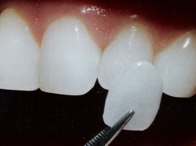 Keramicka zubna faseta